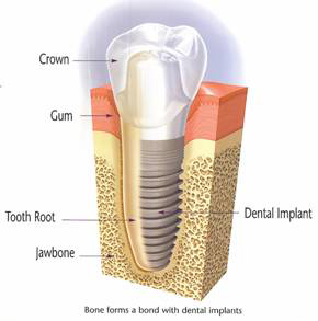A diagram of the parts of a dental implant including crown and metal post..