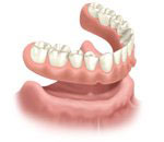 Illustration of dentures above the bottom gumline to demonstrate fit.