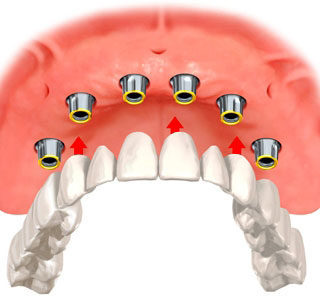 A picture of six implants anchoring a full upper denture.