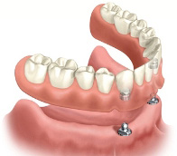Illustration of implant-supported dentures demonstrating anchored fit