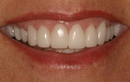 "After" photo showing close up of smile with new porcelain crowns