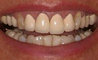 "Before"photo showing close up of smile with old crowns