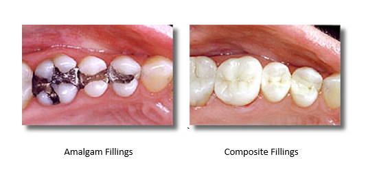 before and after mercury filled silver fillings