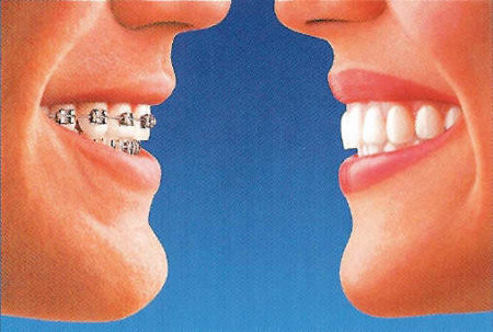 Invisalign versus metal braces