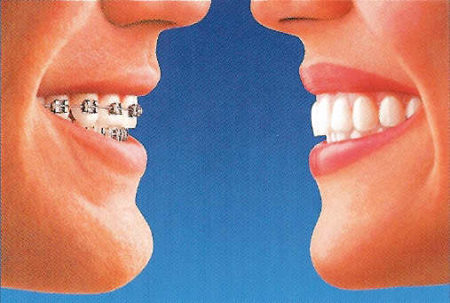 Side by side image of traditional braces versus Invisalign