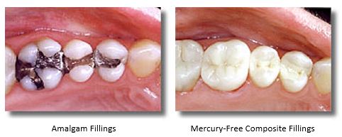 Unattractive amalgam fillings replaced by mercury-free, white composite fillings