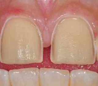 teeth prepped for porcelain veneers