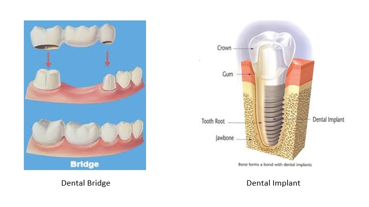 Bridge versus implant