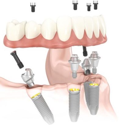 All-on-4 dental implant illustration