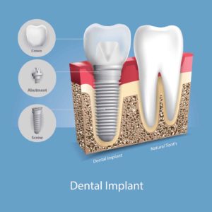 An image of a dental implant next to a tooth.