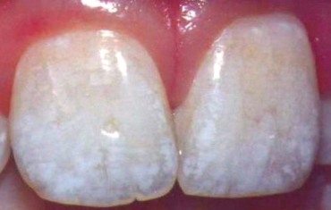 Example of Mild Fluorosis Stains