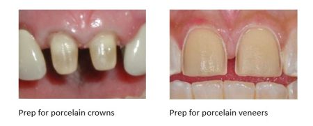 The difference between tooth preparation for porcelain veneers versus porcelain crowns. 