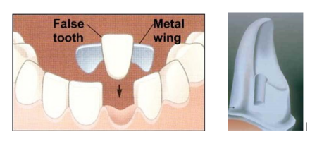 An image of a Maryland Bridge and an image of a tooth being prepped