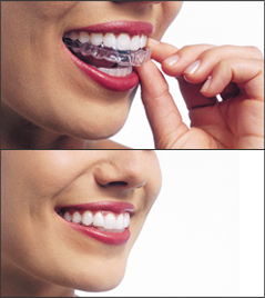 Invisalign / teeth whitening trays
