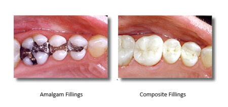A side by side image with the first image having amalgam fillings and the second image having composite fillings